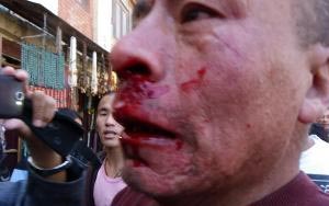 A Tibetan monk who was beaten in Kathmandu